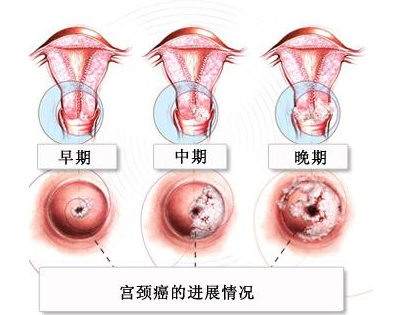 沈丹华：宫颈癌前病变的命名及分类