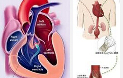 BMJ Open Heart：高<font color="red">敏</font>C反应蛋白可作为轻度中度主动脉瓣狭窄患者降脂的预后指标