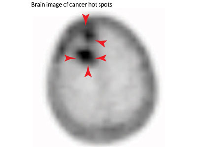STM：以谷氨酸为基础的PET<font color="red">成像</font>能检测神经胶质瘤
