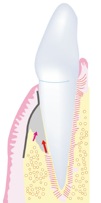 Clin Oral Implants Res：<font color="red">3</font><font color="red">D</font>全景解释牙周组织再生过程中细胞之间是如何沟通的？