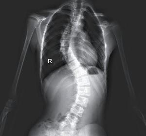 J Pediatr：特发性脊柱侧凸儿童可能具有高阻塞性肺疾病