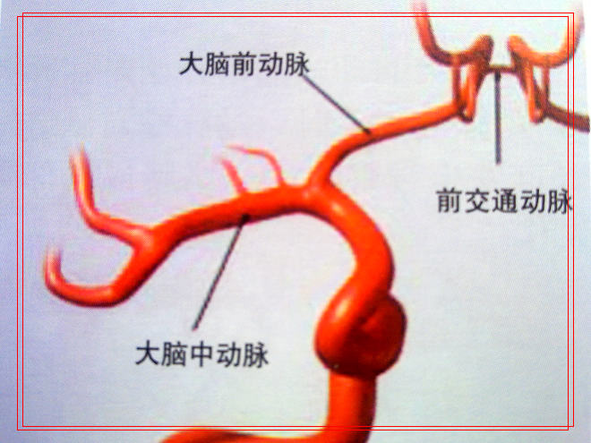 Stroke：颅内动脉瘤的<font color="red">遗传</font><font color="red">背景</font>中存在性别<font color="red">遗传</font>差异