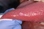 Oral Oncol：口腔HPV感染可致头颈癌