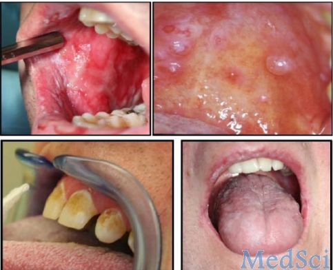 J Dent Res：慢性移植物抗宿主病的口腔疾病表现