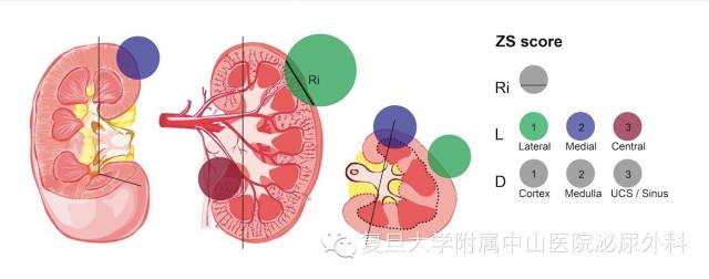 Medicine：中国版肾癌手术评分系统问世--<font color="red">中山</font>评分