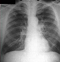原发性肺癌放射治疗的规范解读