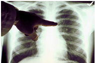 专家解读《中国原发性肺癌诊疗规范（2015年版）》