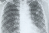 JAMA：LDCT筛查肺癌中的过度诊断