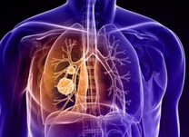 JTO：肿瘤低代谢预示早期非小细胞肺癌患者更高生存率