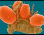 NEJM：基于硼替佐米的方案治疗新诊断的套细胞淋巴瘤