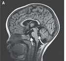 NEJM：MRI技术揭开脑型疟疾患儿致死关键原因---脑水肿！