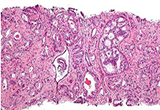 Oncogene：特殊生物标志物可向恶性前列腺癌发送信号促其侵袭