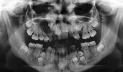 J Dent：X线检查龋齿效果可靠吗？