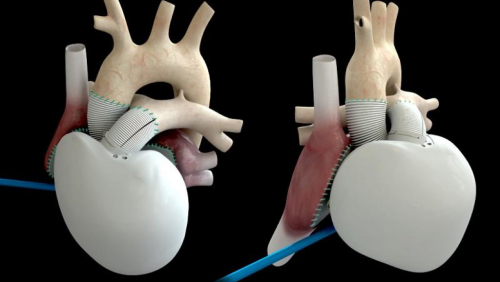 法第三例人工心脏移植手术成功 被赞“医学壮举”