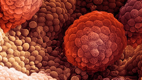 AACR 2015：PARP<font color="red">抑制</font>剂（奥拉帕尼）对晚期前列腺癌可能有效