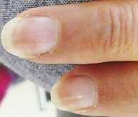 NEJM：慢性肾病，让她失去了美丽的指甲