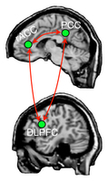Nat Neurology：科学家发现<font color="red">大脑</font>形成决策的<font color="red">区域</font>