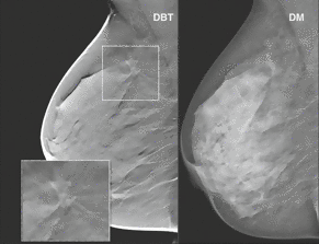 Euro Radio：乳房断层X线影像合成技术可能有助于乳腺癌的筛查