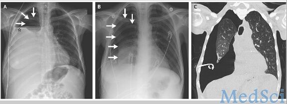 NEJM：胸腔镜技术与肺萎缩