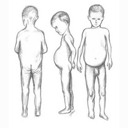 Clin Gastroenterol Hepatol：围产期哪些因素会导致儿童乳糜泻