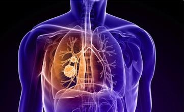 血清巨噬细胞抑制因子-1在肺癌诊断中的临床应用