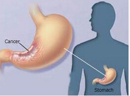 Surgery：胃癌D1+术式能取代D2？