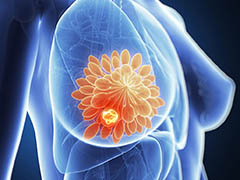 Int J Nanome：科学家利用新型纳米聚合物精准定位乳腺癌