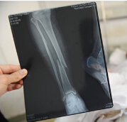 JOT：下肢骨折患者静脉血栓栓塞症的预防