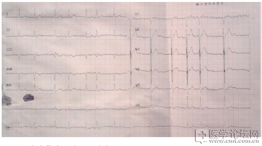 患者体表心电图示房颤-1