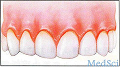 J Periodontal Res：牙龈炎可能参与了系统<font color="red">性疾病</font>的发病机制