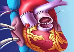 Circulation：经心尖（TA）或经股动脉（TF）经导管主动脉瓣置换术的临床疗效比较