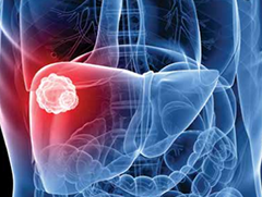 CJON：对肝癌及转移性肝癌合理使用HAIP