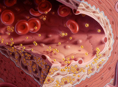 JACC：血透患者肠道胆固醇吸收水平或影响阿托伐他汀<font color="red">治疗效果</font>