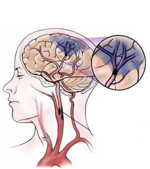 TISC 2015：2015中国脑血管病一级预防指南解读