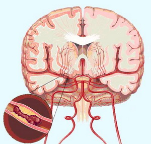 新版脑出血管理指南之早期强化降压治疗