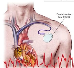 JAMA：急性<font color="red">心肌梗死</font>后低射血分数患者的植入式心脏除颤器的使用