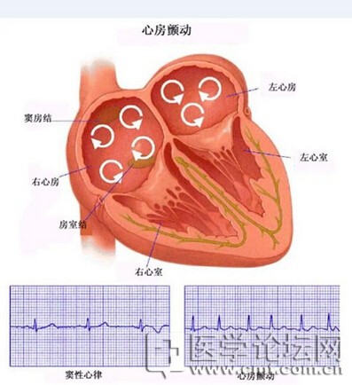 Hypertension：收缩压<font color="red">控制</font><font color="red">良好</font>降高<font color="red">血压</font>患者新发房颤风险