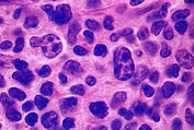 Lancet Haematology：硼替佐米联合帕比司他治疗复发性或难治性外周T细胞淋巴<font color="red">瘤</font>