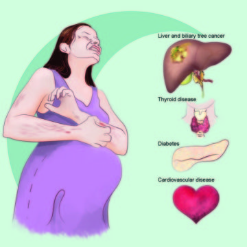 J Hepatol：肝内胆汁淤积的孕妇或患<font color="red">肝脏</font>癌症的风险较高