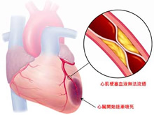 AMI后心脏损伤全新分级标准意味着什么？
