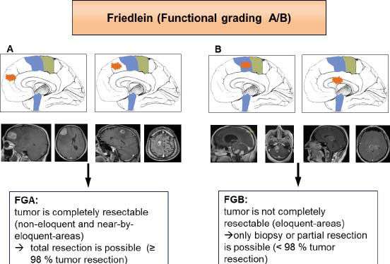 Scientific Reports：神经胶质瘤新分级---Friedlein分级A / B