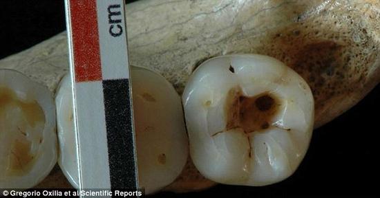 Sci Rep：1.4万年前牙医能开展牙科手术