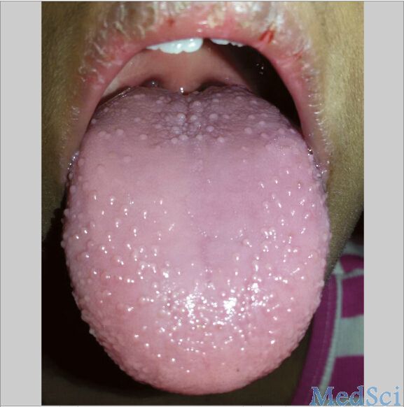 川崎病舌头图片 早期图片