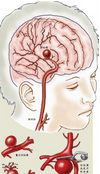 NEJM：脑巨动脉瘤案例报道