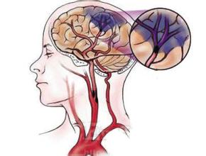 Stroke：急性缺血性脑卒中患者血小板的反应性随<font color="red">阿司匹林</font>变化的临床意义