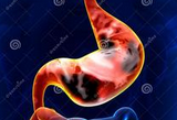 J Cell Biol：樊代明院士发现<font color="red">miR-7</font>可抑制胃癌的发展