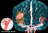 Stroke：脑内出血后认知功能下降的预测因素