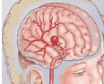 Stroke:：遗传<font color="red">变异</font>与颅内动脉瘤的大小存在显著相关性