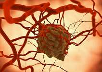 JNCI：血管瘤逃避免疫系统追杀新机制
