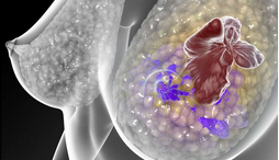 <font color="red">STM</font>：新型“突变-追踪”血液检查预测乳癌复发